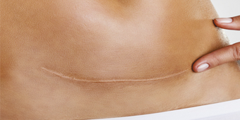 Biomax Improves Stretch Marks After Surgery