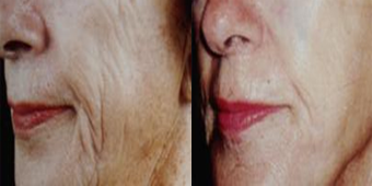 Serumax Anti Aging Facial Serum female
