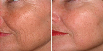 Serumax Australias Best Wrinkle Facial Serum Fem
